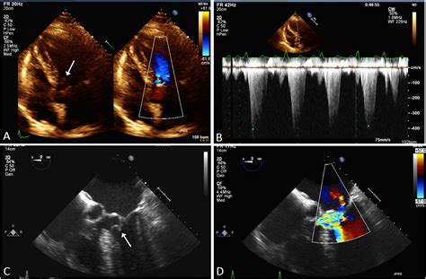 dynamic left ventricular outflow.